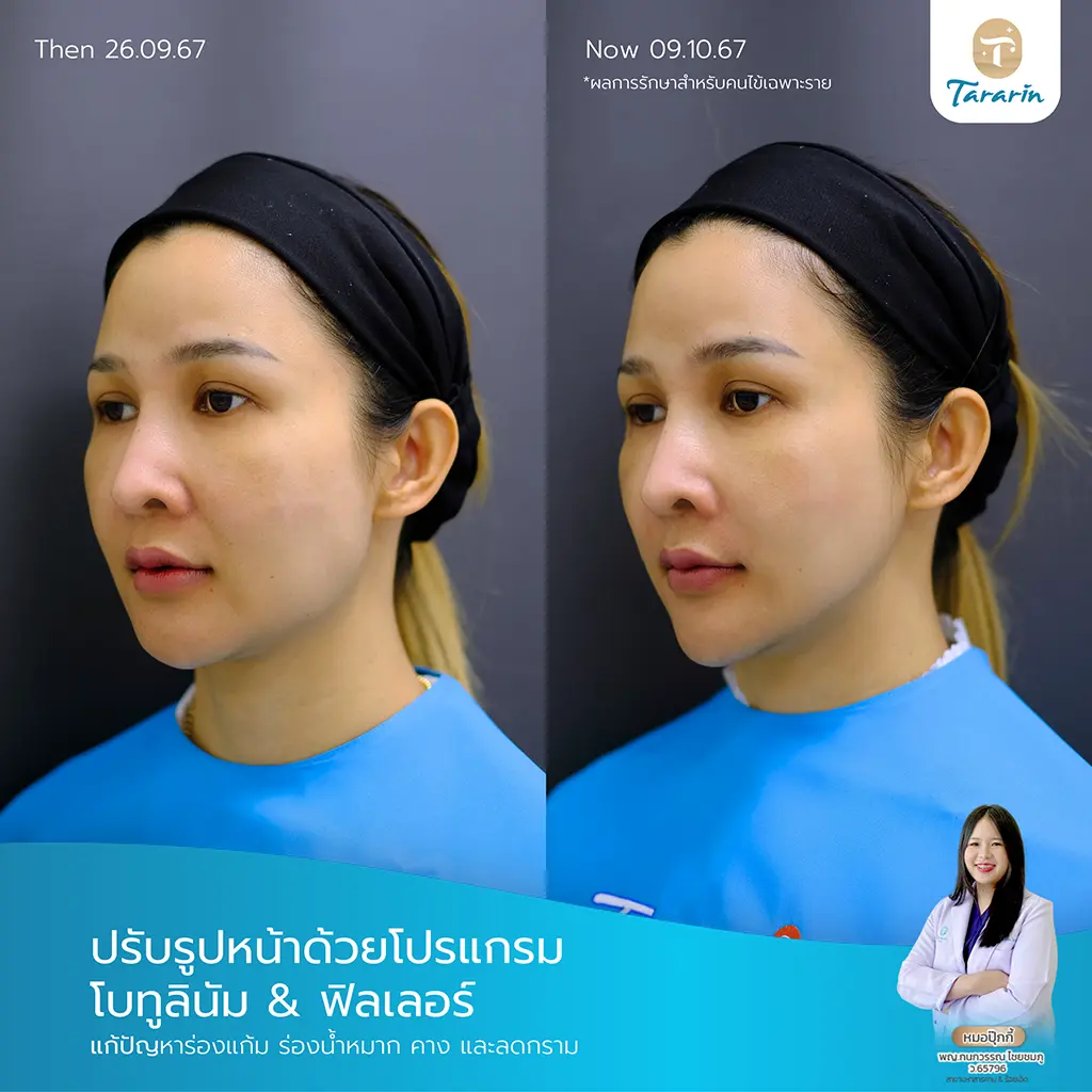 รีวิวประสบการณ์จริงจากผู้ใช้บริการปรับรูปหน้า